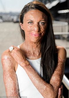 Turia Pitt